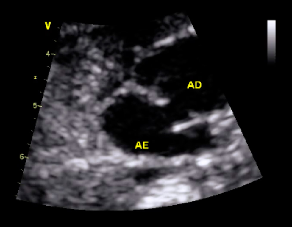 Demonstrativos Ecocardiograma Fetal Clínica Oftcor 